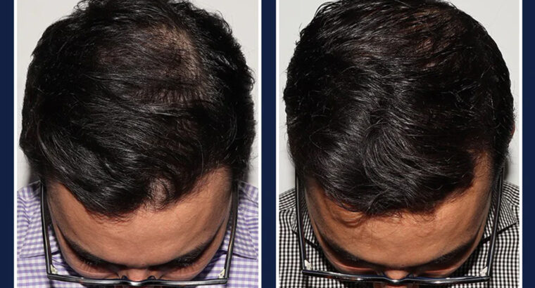 بخاخ لنمو الشعر يحتوي على مكونات نباتية طبيعية