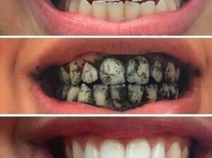 البودرة السريعةلتبييض الاسنان هتخلصك مشاكل الاسنان