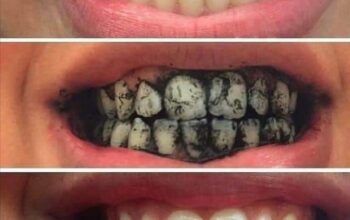 البودرة السريعةلتبييض الاسنان هتخلصك مشاكل الاسنان